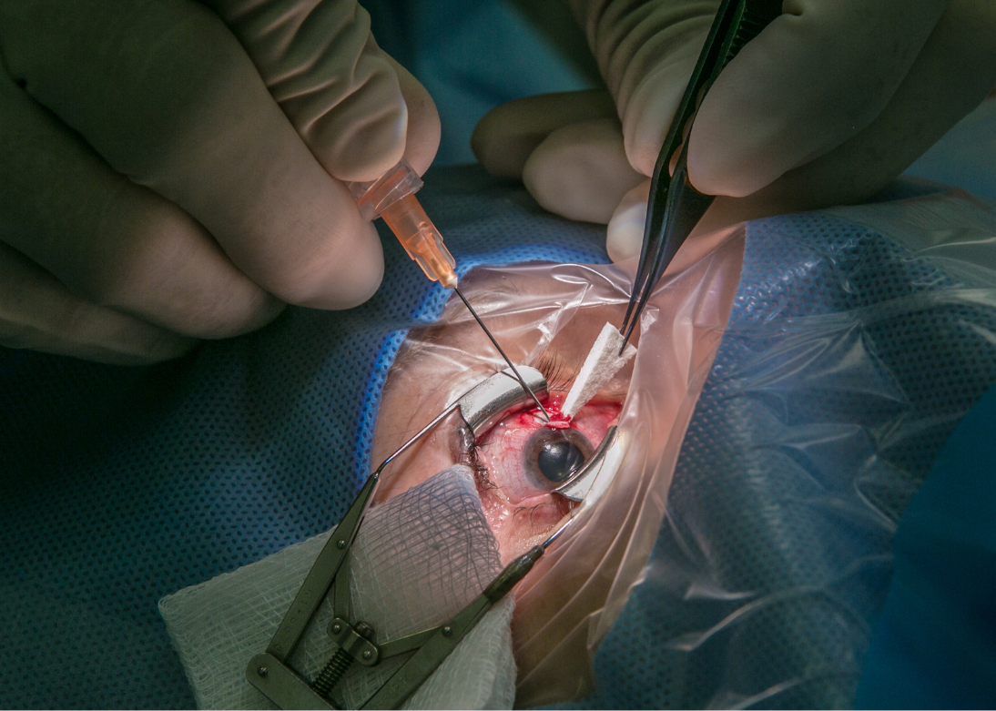 ICL Implantation